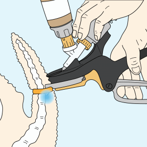 Numnuts® for taildocking diagram. Numnuts delivers local anaesthetic in combination with an Elastrator rubber ring